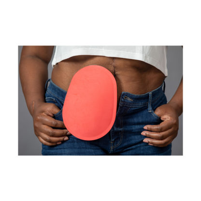 Ostique Sk.ns Ostomy Pouch Cover